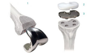 Artroplastia Total de Joelho