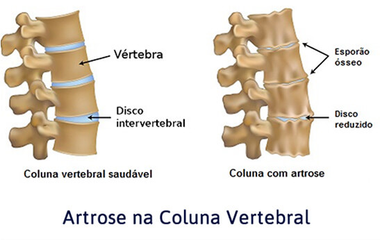 Artrose na Coluna Artrose na Coluna