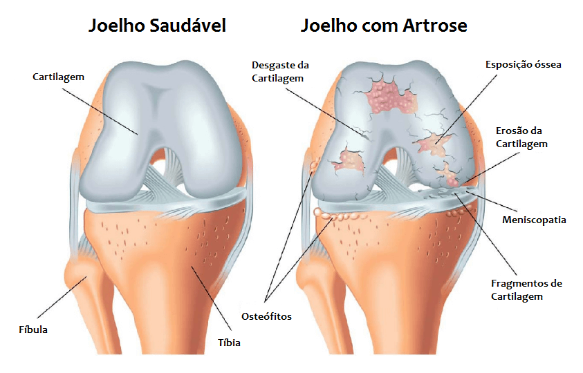 Artrose do Joelho Artrose do Joelho