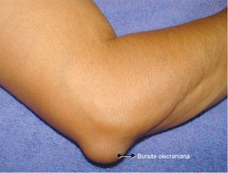 Bursite no Cotovelo