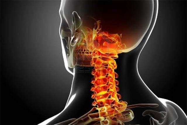 Cervicalgia Cervicalgia