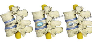 Cifoplastia