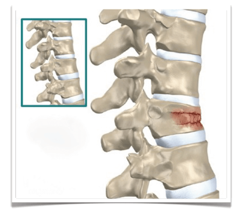 Cifoplastia Cifoplastia