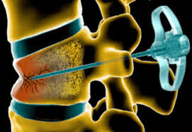 Cifoplastia