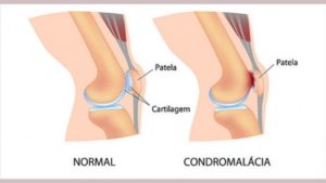 Condromalácia Patelar