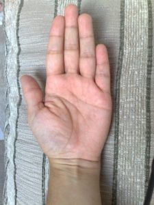 Contratura de Dupuytren