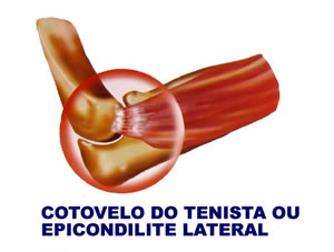 Cotovelo de Tenista