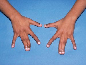 Deformidades Congênitas - Sindactilia