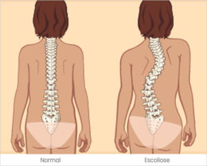 Escoliose