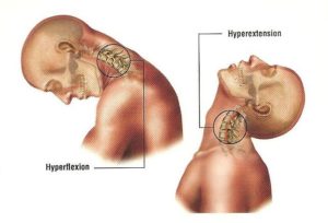 Fratura Cervical