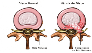 Hérnia de Disco