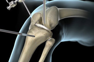Lesão do Ligamento Cruzado Anterior