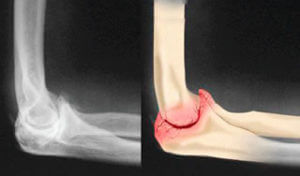 Osteoartrite do Cotovelo