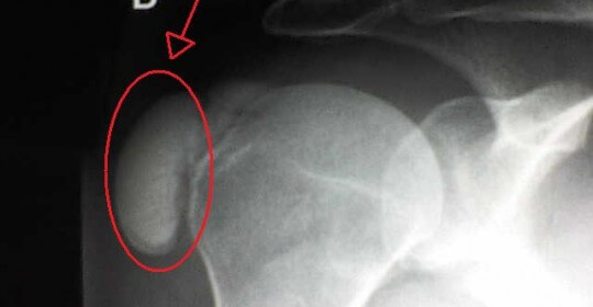 Tendinite Calcária