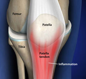 Tendinite Patelar