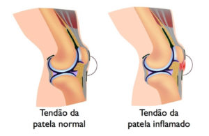Tendinite Patelar