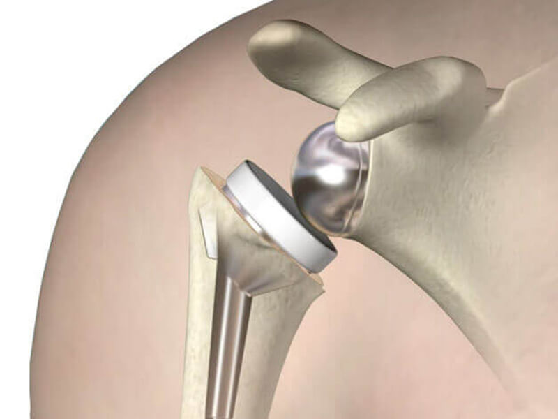Artroplastia de Ombro