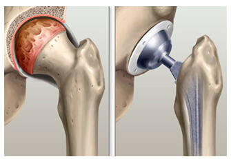 Artroplastia de Quadril