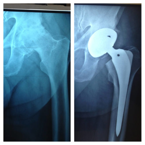 Artroplastia de Quadril Artroplastia de Quadril