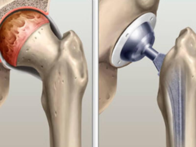 Artroplastia de Quadril