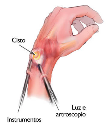 Artroscopia do punho