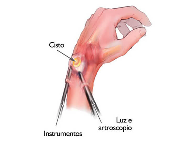 Artroscopia do Pulso