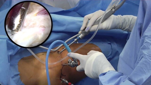 Artroscopia do Quadril