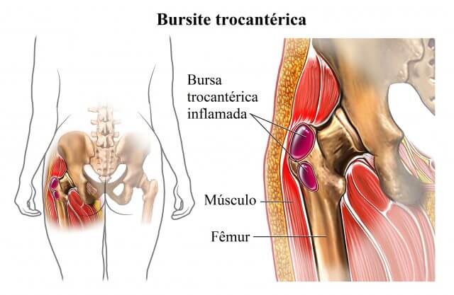 Bursite no Quadril Bursite no Quadril