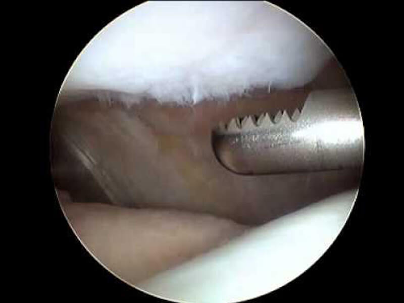 Condroplastia