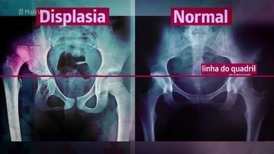 Displasia do Quadril