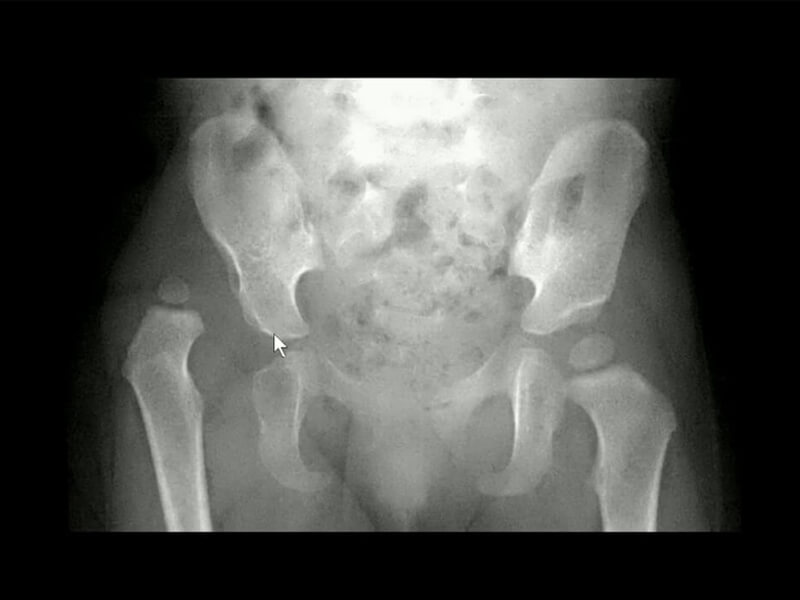 Displasia do Quadril