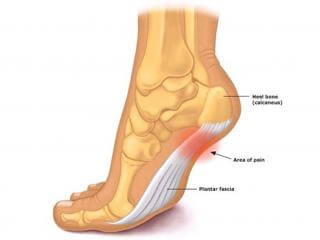 Fascite Plantar