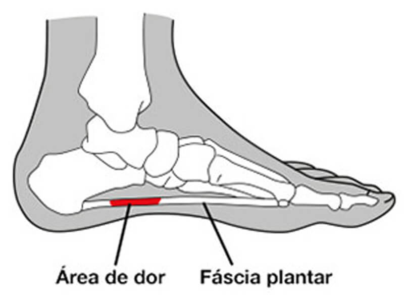 Fascite Plantar