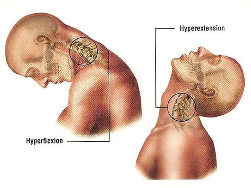 Fratura Cervical