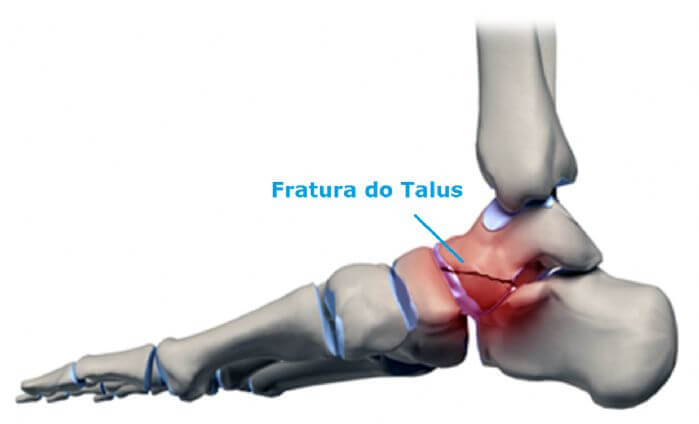 Fratura de Tálus