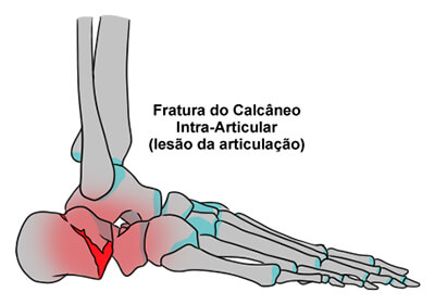 Fratura do Calcâneo