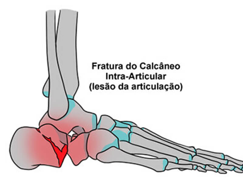 Fratura do Calcâneo