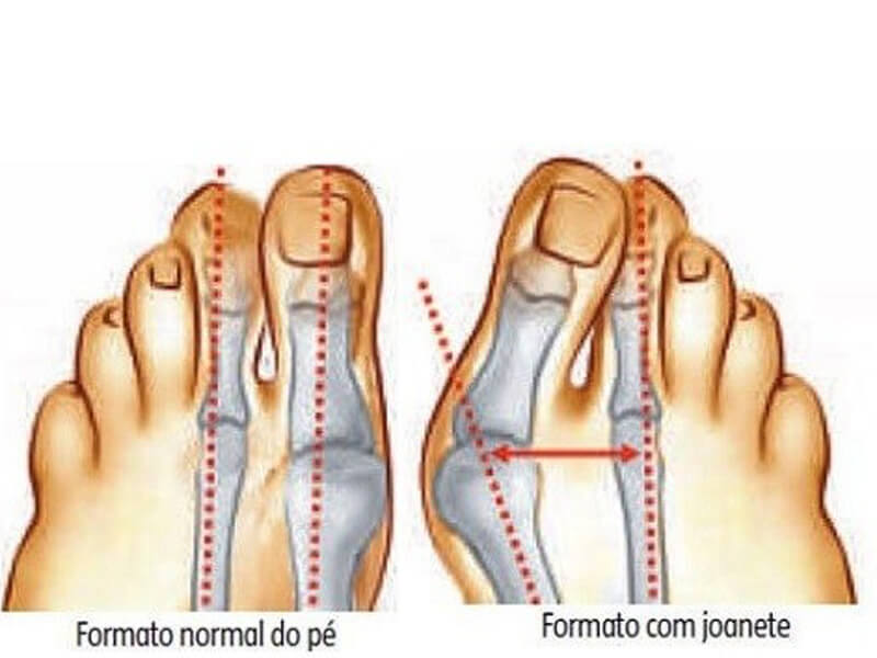 Halux Valgo Joanete