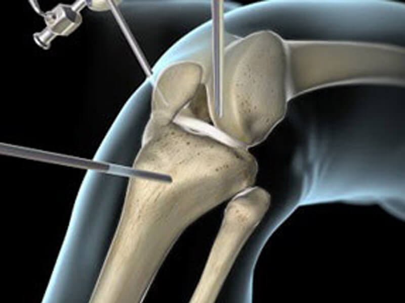 Ligamento Cruzado Anterior