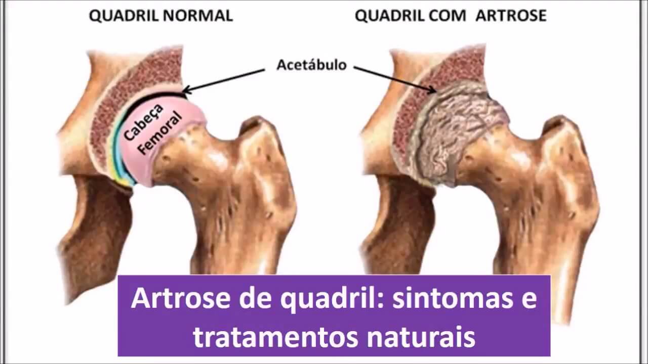 Osteoartrose do Quadril Osteoartrose do Quadril
