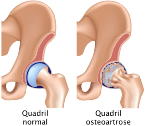 Osteoartrose do Quadril