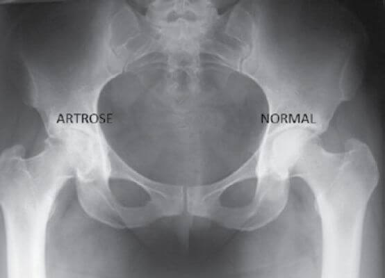 Osteoartrose do Quadril Osteoartrose do Quadril