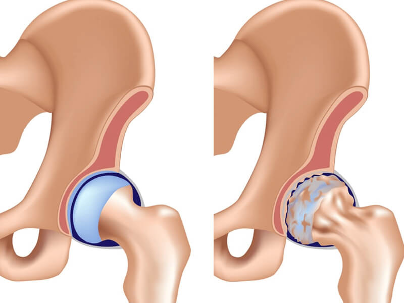 Osteoartrose do Quadril