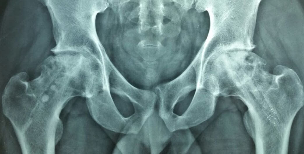 Osteonecrose do Quadril