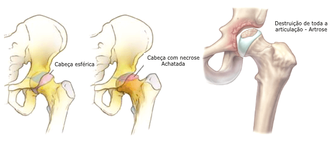 Osteonecrose do Quadril