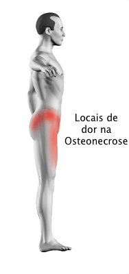 Osteonecrose do Quadril