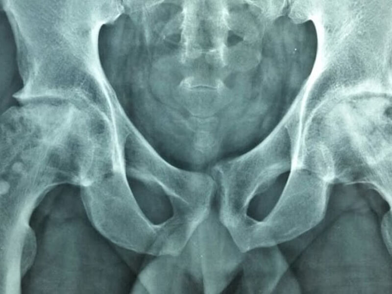 Osteonecrose do Quadril