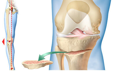 Osteotomia