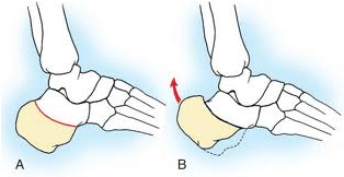 Osteotomia