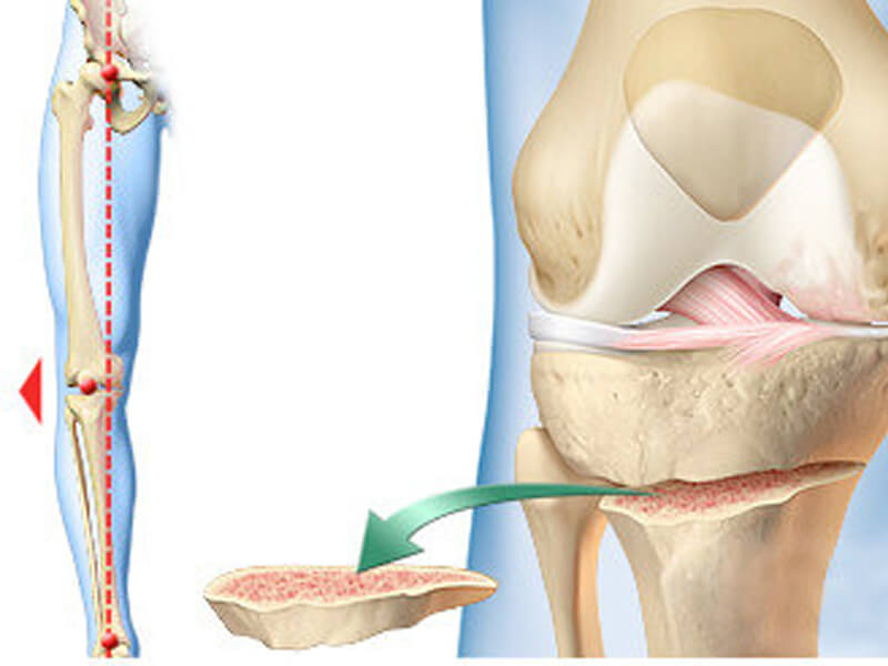 Osteotomia